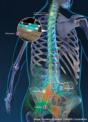 coping with scoliosis essay coping with scoliosis essay