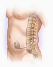 implanted intrathecal drug delivery pump