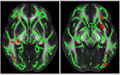 Alzheimer's disease brain image