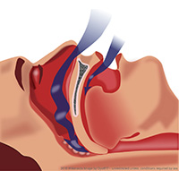 Obstructive sleep apnea