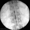 Image 08334: Implantation of Epidural Spinal Cord Stimulator Illustration